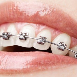 Orthodontic Treatment